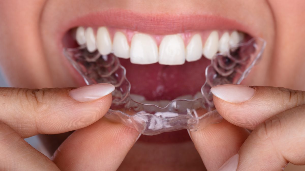Invisalign vs. Braces: Which Is Right For You? - Matthews, NC
