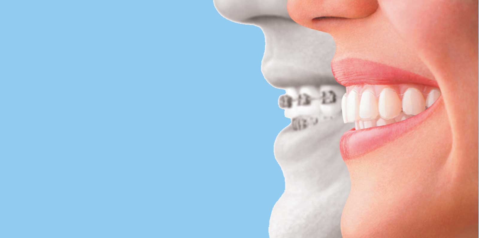 Can Invisalign Clear Aligners Fix an Overbite