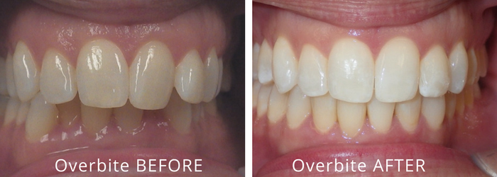 What is an Overbite and how easy is it to fix? - Clear Smiles