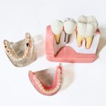 Overdentures vs. Implants