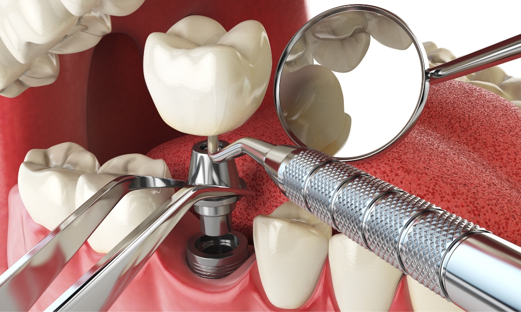Dental Implant Process Timeline