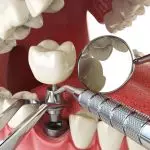 dental implant process timeline