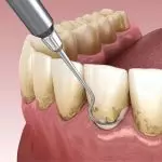 gumline cavity
