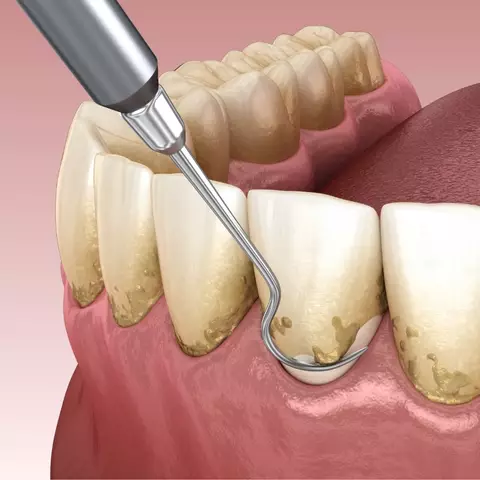 gumline cavity