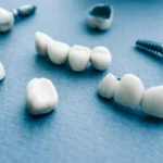 Surgical orthodontics, ceramic dental implants in Matthews, NC