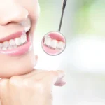 Healthy teeth of a female patient after visiting a cosmetic dentist in Matthews, NC