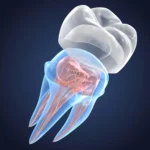 3D-rendering-of-transparent-teeth-showing-same-day-crowns-in-Matthews-NC