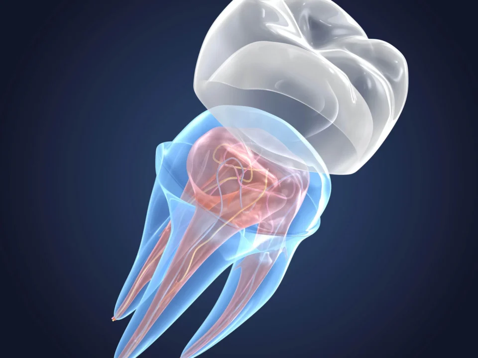 3D-rendering-of-transparent-teeth-showing-same-day-crowns-in-Matthews-NC