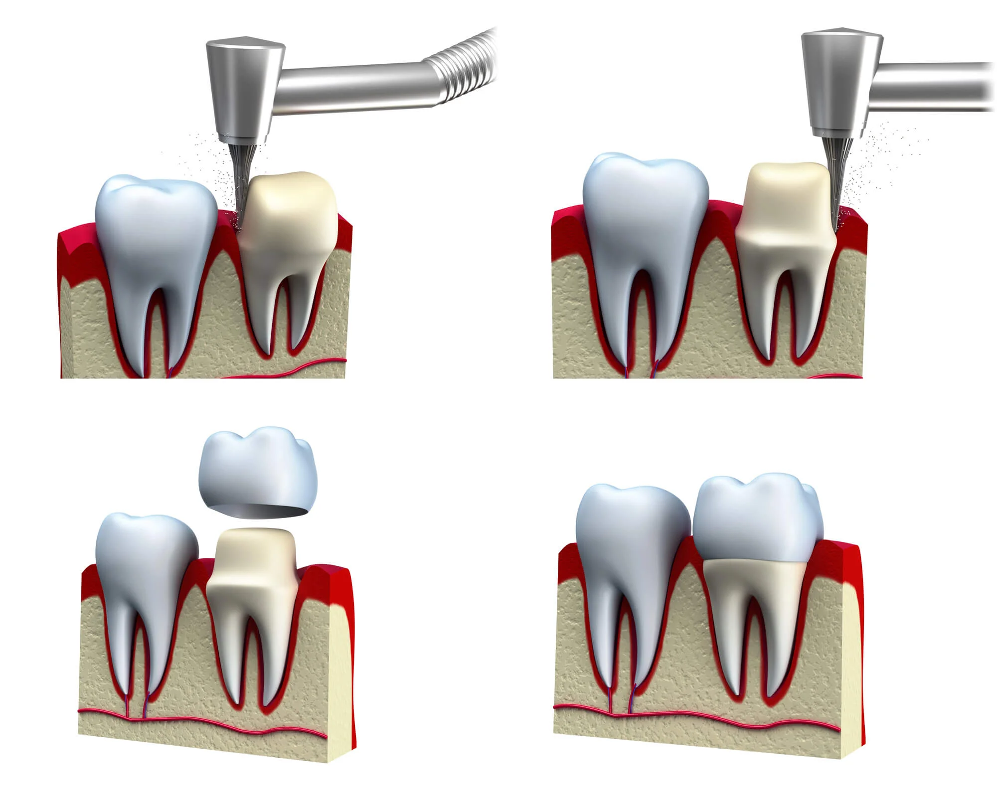 Step-by-step-installation-of-same-day-crowns-in-Matthews-NC