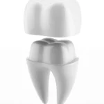 Dental-crowns-in-Matthews-NC.