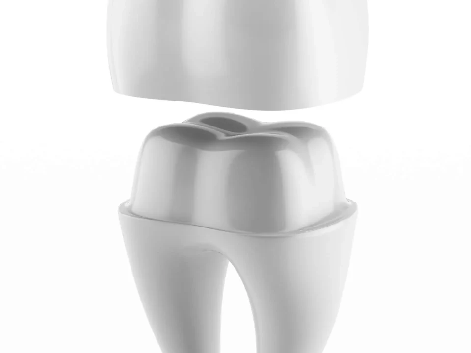 Dental-crowns-in-Matthews-NC.