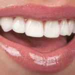 Beautiful-Teeth-Enhanced-with-Veneers-Matthews-NC