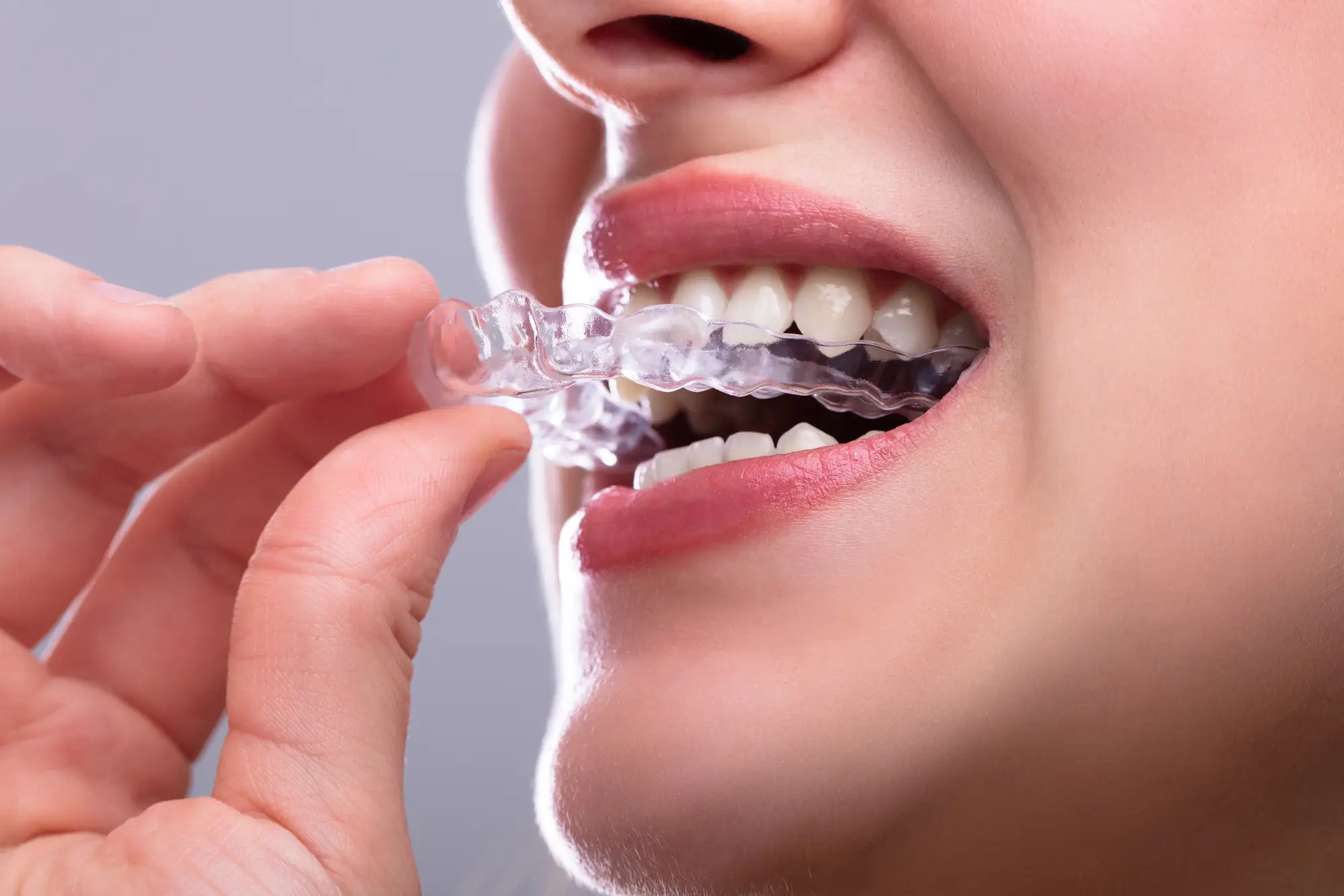 Clear Aligner by Invisalign Dentist Matthews NC