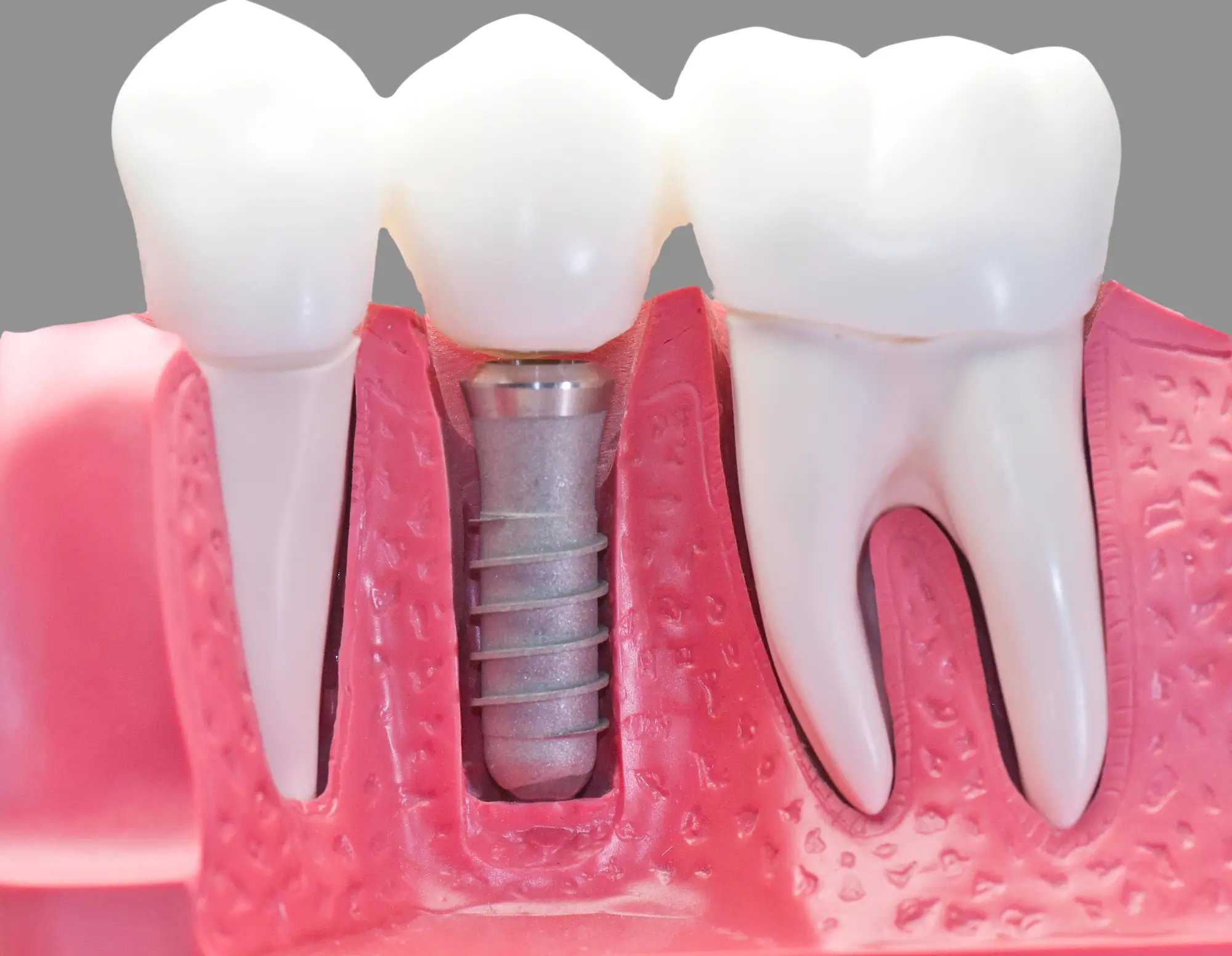 Capped Dental Implants in Matthews, NC Model