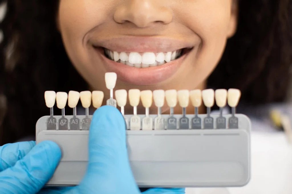 Dentist uses a shade guide for porcelain veneers with a cosmetic dentist Matthews NC