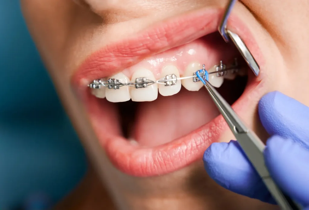 Woman receiving braces treatment from a cosmetic dentist Matthews NC